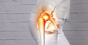 image arthrose hanche