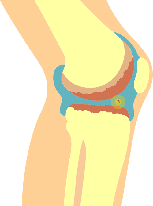 Schéma d'une articulation avec arthrose