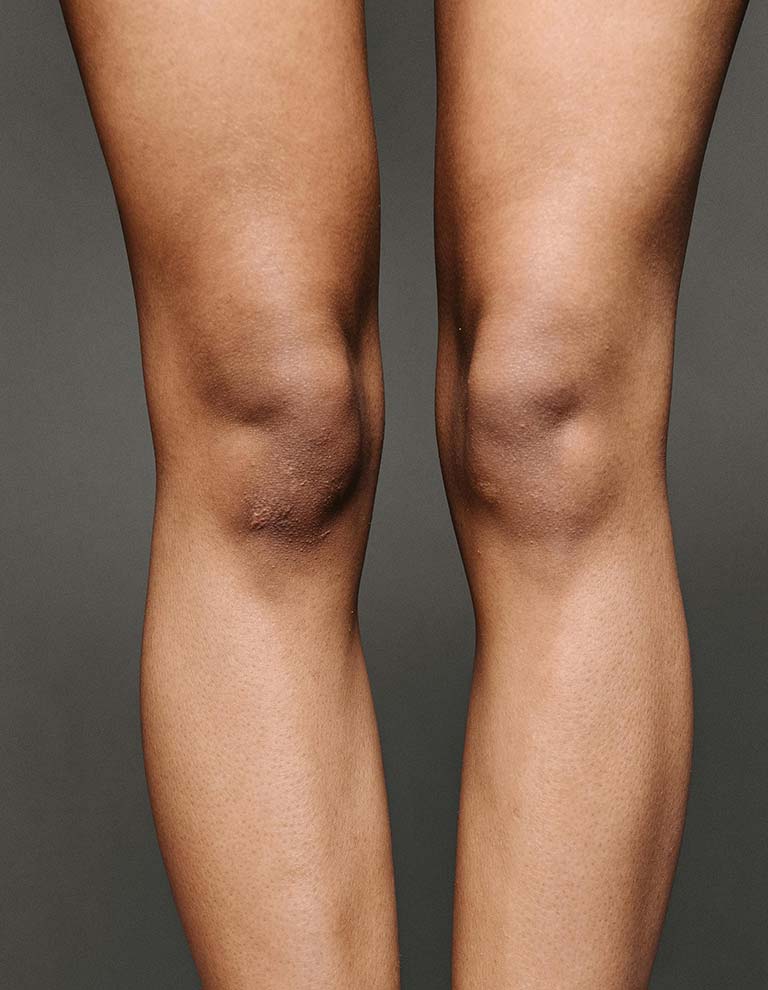 Arthrose du genou