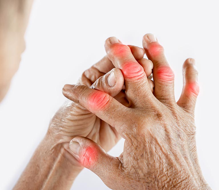 Reconnaître les signes de l’arthrose des doigts